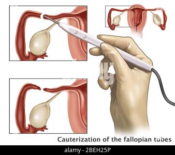 Cauterizzazione dei tubi di Falloppio Foto Stock