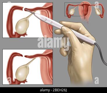 Cauterizzazione dei tubi di Falloppio Foto Stock