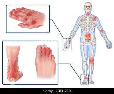 Sintomi dell'artrite psoriasica Foto Stock