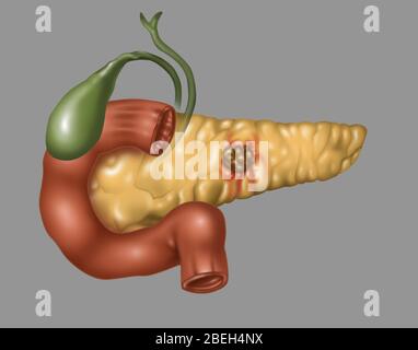 Cancro pancreatico, illustrazione Foto Stock