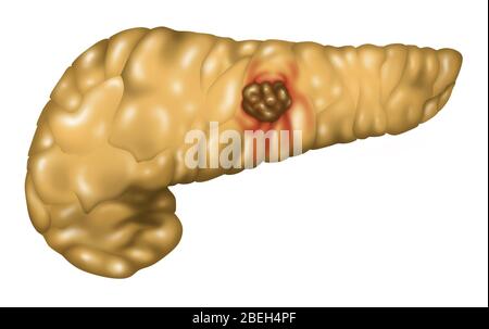 Cancro pancreatico, illustrazione Foto Stock