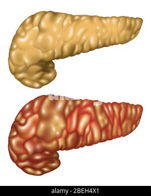 Pancreas illustrazione, sano e infiammato Foto Stock