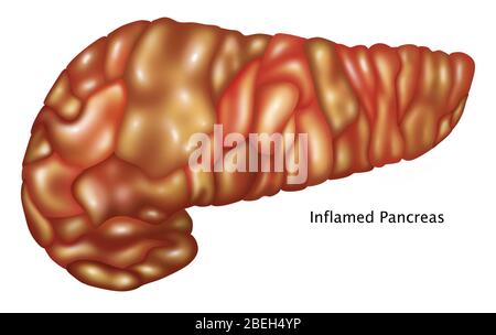 Infiammazione del pancreas, illustrazione Foto Stock