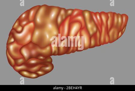 Infiammazione del pancreas, illustrazione Foto Stock