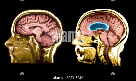 MRI del cervello normale e del cervello idrocefalo Foto Stock