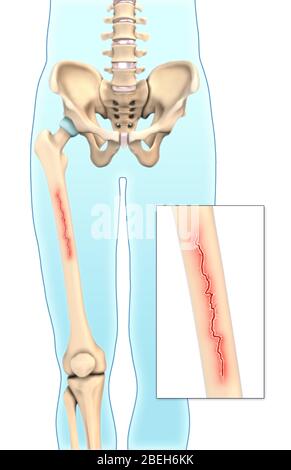 Un'illustrazione di una frattura lineare in cui si verifica una rottura lungo l'asse lungo dell'osso. Foto Stock