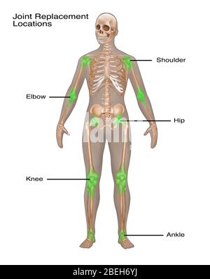 Infiammazione articolare, illustrazione Foto Stock