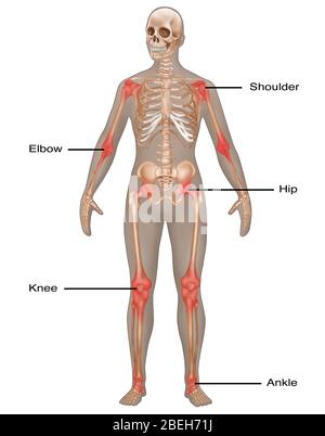Infiammazione articolare, illustrazione Foto Stock