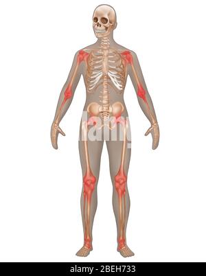 Infiammazione articolare, illustrazione Foto Stock