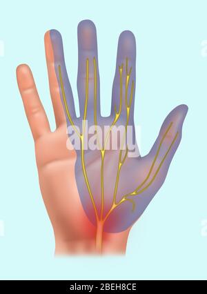 Sindrome del tunnel carpale, illustrazione Foto Stock