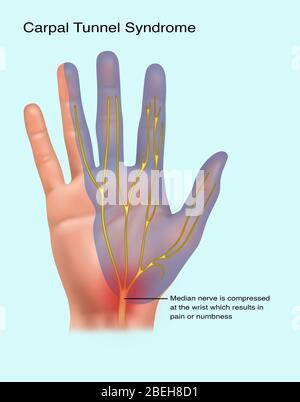 Sindrome del tunnel carpale, illustrazione Foto Stock