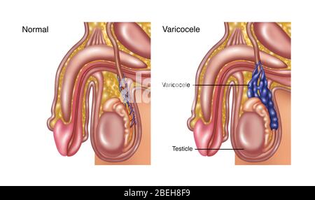 Varicocele scrotale, illustrazione Foto Stock