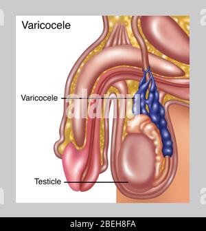 Varicocele scrotale, illustrazione Foto Stock