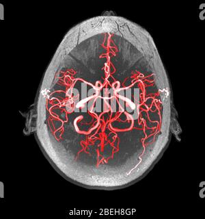 Arterie del cervello, MRA Foto Stock