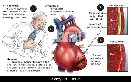Pericardite, illustrazione Foto Stock