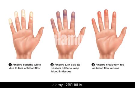 Opuscolo informativo sulla malattia di Raynaud Foto Stock