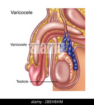 Varicocele scrotale, illustrazione Foto Stock