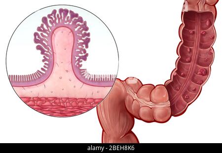 Polipo colorettale peduncolato, illustrazione Foto Stock
