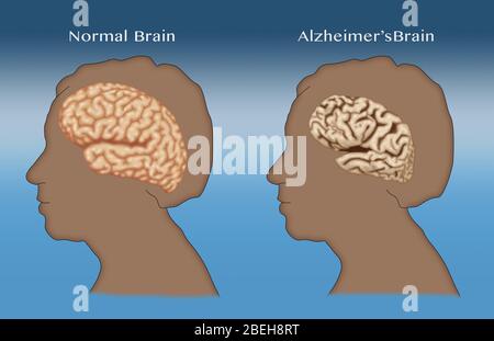 Alzheimer e cervello normale, confronto Foto Stock