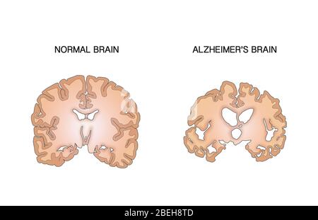 Alzheimer e cervello normale, confronto Foto Stock