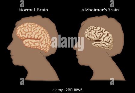 Alzheimer e cervello normale, confronto Foto Stock