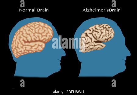 Alzheimer e cervello normale, confronto Foto Stock