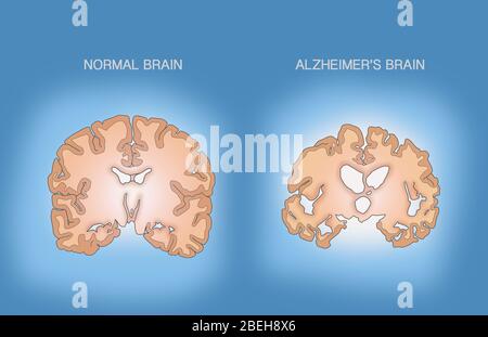 Alzheimer e cervello normale, confronto Foto Stock