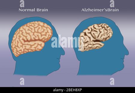 Alzheimer e cervello normale, confronto Foto Stock