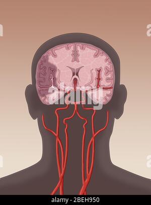 Ictus ischemico. In un ictus ischemico un coagulo blocca il flusso sanguigno verso un'area del cervello. Foto Stock