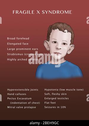 Sintomi della sindrome X fragile. Illustrazione. Foto Stock