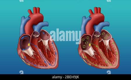 Fibrillazione cardiaca e atriale, illustrazione Foto Stock
