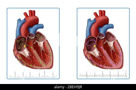 Fibrillazione atriale e flutter, illustrazione Foto Stock