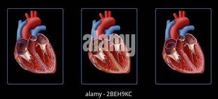 Illustrazione che confronta un muscolo cardiaco con un battito cardiaco normale e un battito cardiaco irregolare. Che mostra un cuore normale (a sinistra), un cuore con fibrillazione atriale (al centro) e un cuore con flutter atriale (a destra). Come mostrato nell'illustrazione nella fibrillazione atriale (Afib), i segnali elettrici disorganizzati (cerchi verdi) provengono dal nodo SA (punto giallo). Con il flutter atriale, i segnali elettrici viaggiano intorno e intorno all'interno dell'atrio (cerchio rosa); questi segnali di cerchio rendono il battito dell'atrio troppo veloce. Foto Stock