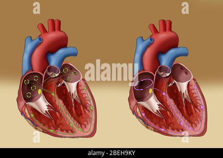 Fibrillazione atriale e flutter, illustrazione Foto Stock