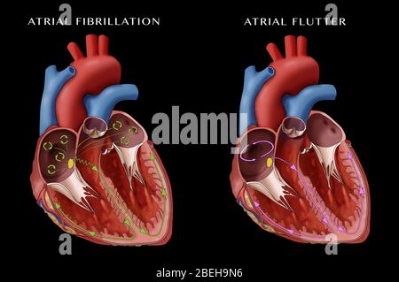 Fibrillazione atriale e flutter, illustrazione Foto Stock