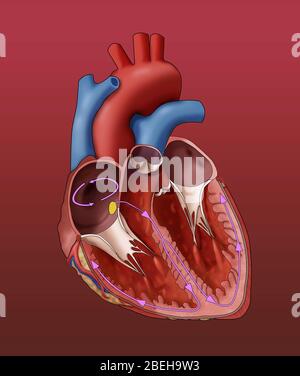 Illustrazione di un cuore che mostra un flutter atriale, un ritmo cardiaco anomalo. Come mostrato qui, i segnali elettrici viaggiano intorno e intorno all'interno dell'atrio (cerchio rosa); questi segnali di cerchio fanno battere l'atrio troppo velocemente. Foto Stock