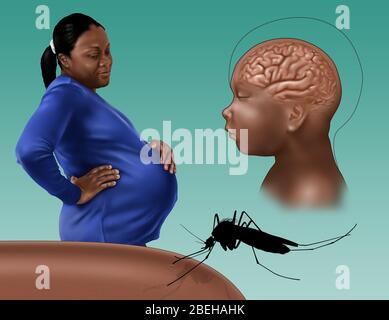 La microcefalia è una condizione medica in cui il cervello non si sviluppa correttamente, con conseguente riduzione della testa rispetto al normale. La microcefalia può essere presente alla nascita o può svilupparsi nei primi anni di vita. Spesso le persone con il disturbo hanno una disabilità intellettuale, una scarsa funzionalità motoria, un linguaggio scarso, caratteristiche facciali anormali, convulsioni e dwarfismo. I bambini possono soffrire di microcefalia congenita se le loro madri sono state infettate con il virus Zika durante la gravidanza. Il virus Zika è un flavivirus di zanzara strettamente collegato al virus dengue. La trasmissione avviene principalmente tramite i puntini da Foto Stock