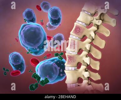 Un'illustrazione del mieloma multiplo, un tipo di cancro dei globuli bianchi che interessa le cellule del plasma. Le cellule plasmatiche maturano a partire dai linfociti B nel midollo osseo e producono anticorpi usati per combattere le infezioni. Tuttavia, varie mutazioni geniche possono alterare questo processo, causando una proliferazione di cellule plasmatiche e una sovrapproduzione di anticorpi. Le cellule plasmatiche maligne nel midollo osseo possono interferire con la produzione di cellule del sangue normali e causare lesioni ossee, osteoporosi, fratture ossee patologiche e ipercalcemia. Foto Stock