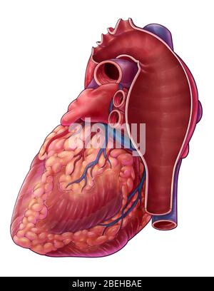 Aneurisma aortico toracico, illustrazione Foto Stock