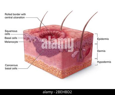Illustrazione del carcinoma basocellulare Foto Stock