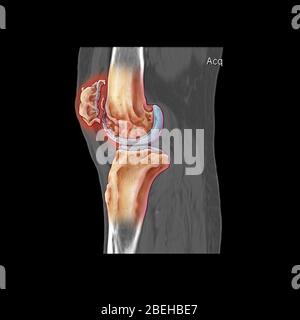 Ginocchio che mostra l'osteoporosi Foto Stock