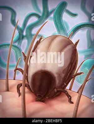 Malattia di Lyme, illustrazione Foto Stock