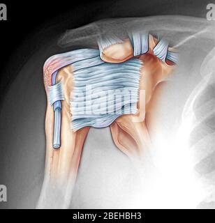 Tendinite calcificante Foto Stock