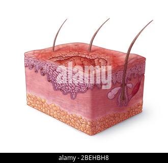 Carcinoma a cellule squamose Illustrazione Foto Stock