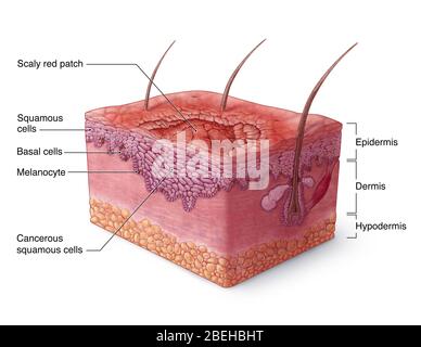 Carcinoma a cellule squamose Illustrazione Foto Stock