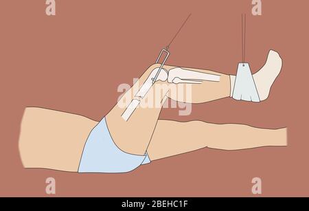 Femore rotto in trazione Foto Stock