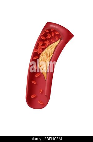 Arteriosclerotico Malattia coronarica Foto Stock