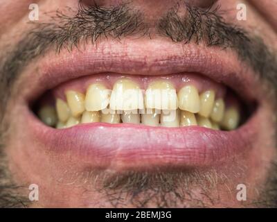 Foto ravvicinata con messa a fuoco al centro della parte maschile del viso con un grin con una placca sui denti Foto Stock