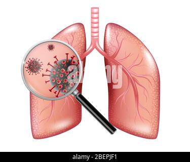 Epidemia realistica del virus Corona. Striscione di coronavirus con polmoni infetti e lente di ingrandimento isolata su bianco. Vettore Illustrazione Vettoriale