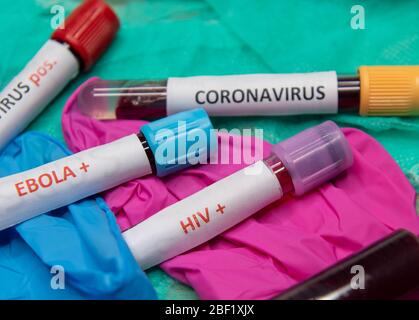 Provetta con sangue e test positivo a HIV. Ed Ebola Foto Stock